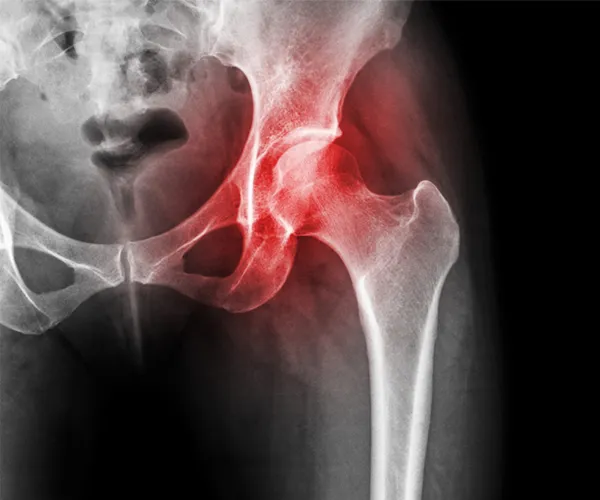 علاج نخر الأوعية الدموية في الهند